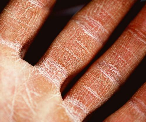 Should you consider taking a bleach bath to treat your eczema? Bona Magazine