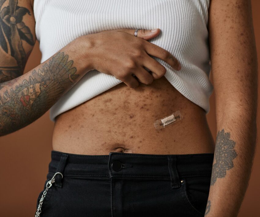 Body acne. Picture: Pexels