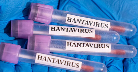 ANKARA, TURKIYE - MAY 06: In this photo illustration Hantavirus samples are seen in Ankara, Turkiye on May 06,, 2026. (Photo by Arman Onal/Anadolu via Getty Images)
