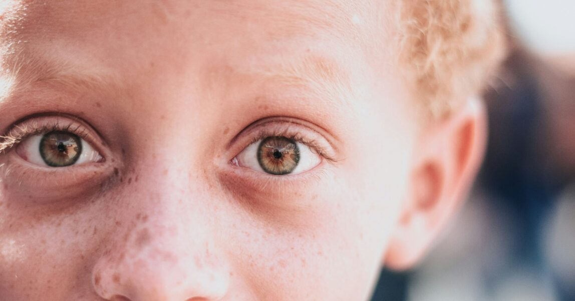 Understanding and caring for a child living with albinism.