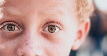 Understanding and caring for a child living with albinism.