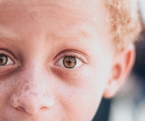 Understanding and caring for a child living with albinism.